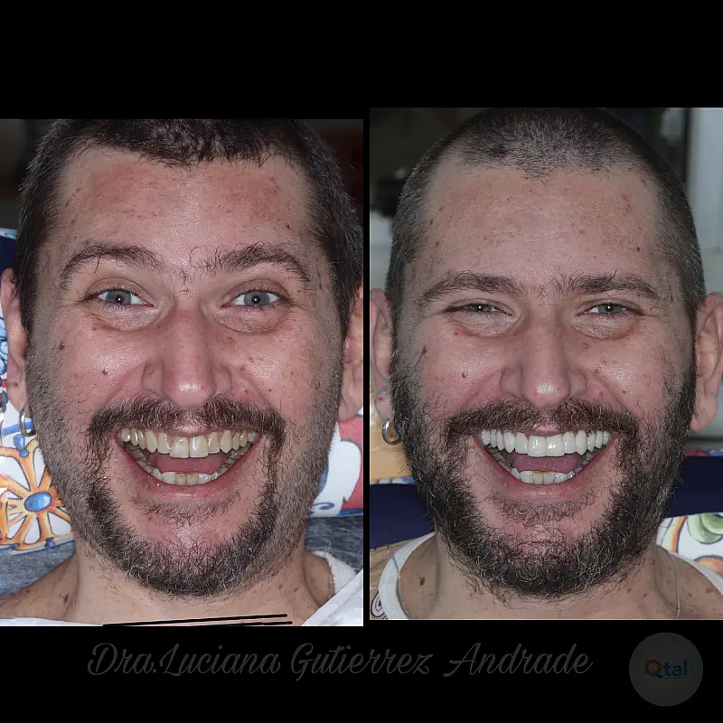 Resultado de lentes de contato dentais