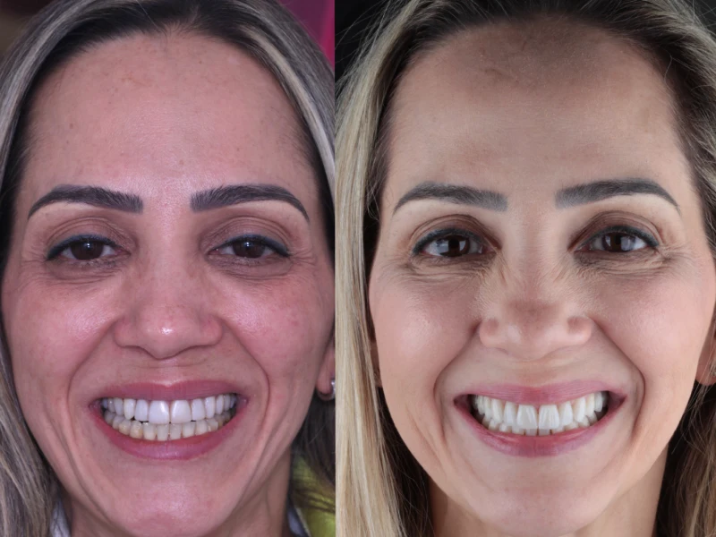 Resultado de lentes de contato dentais